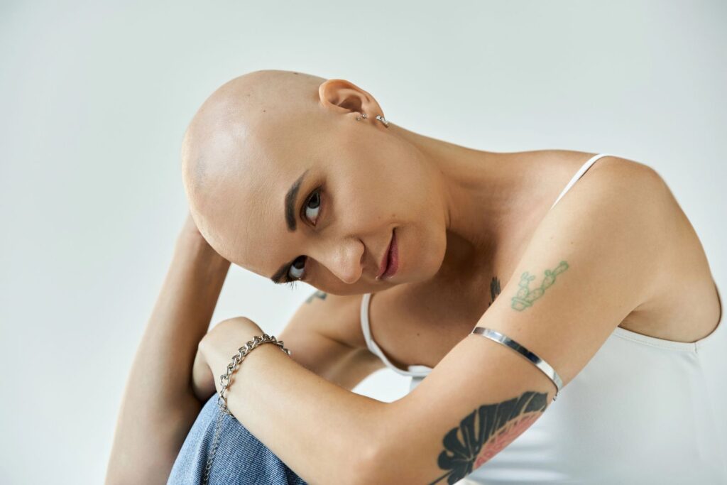 young woman with full alopcia hair loss